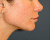 Feel Beautiful - Chin Implant 201 - After Photo